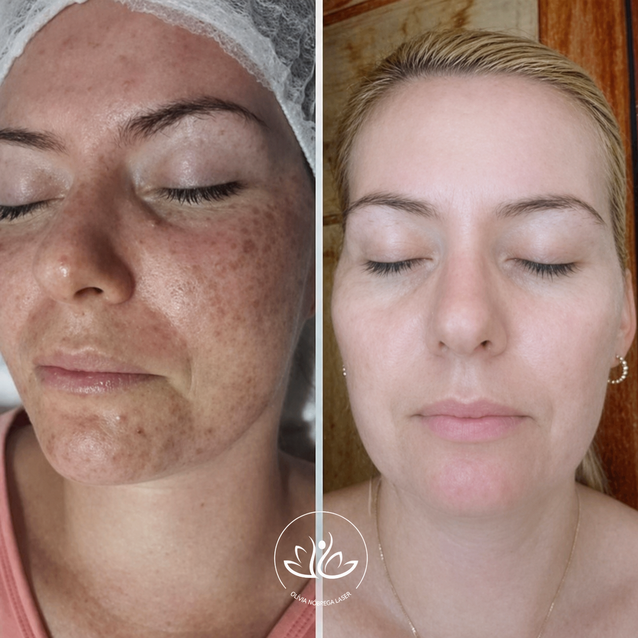 Resultado antes e depois 2